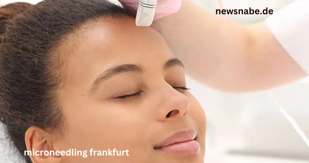 Microneedling Frankfurt